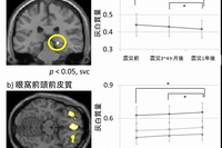 右海馬体積（a）と眼窩前頭皮質体積(b)の震災前、震災3～4か月後、震災1年後の推移を示した図。東北大の発表資料より。