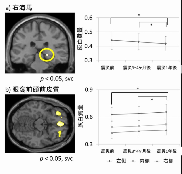 右海馬体積（a）と眼窩前頭皮質体積(b)の震災前、震災3～4か月後、震災1年後の推移を示した図。東北大の発表資料より。