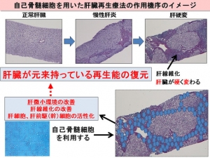 自己骨髄細胞を用いた肝臓再生療法の作用機序のイメージ（山口大学の発表資料より）