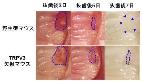 マウス口腔内の写真。TRPV3欠損マウスでは、青い線で囲まれた抜歯後の傷の面積が野生型マウスよりも広い（九州大学の発表資料より）