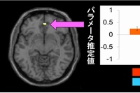 ASD群がASD文を判断し、TD群がTD文を判断する際に、腹内側前頭前野が有意に活動した（京都大学の発表資料より）