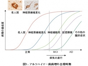 アルツハイマー病病理の出現時期を示す図。老人斑はアルツハイマー病発症の20年以上も前から形成され始める。MCI：軽度認知障害、AD：アルツハイマー病（大阪市立大学の発表資料より）