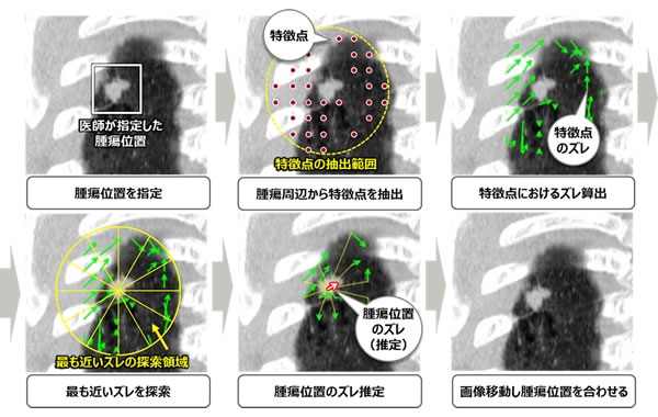 開発技術による腫瘍位置の位置合わせ(富士通研究所の発表資料より)