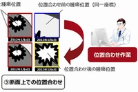 画像比較による腫瘍の経時変化の観察(富士通研究所の発表資料より)