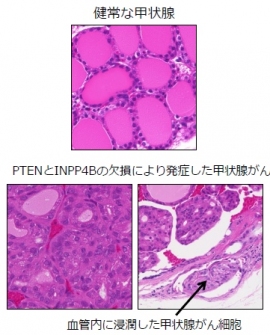 健康な甲状腺とPTENとINPP4Bの欠損によって発症した甲状腺がん（秋田大学の発表資料より）