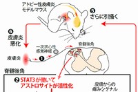 今回の研究で明らかになった、アトピー性皮膚炎の慢性的な痒みが生じるメカニズムの概要を示す図。（九州大学の発表資料より）