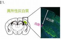 子宮内胎児脳電気穿孔法によって3種の遺伝子をそれぞれ導入することにより、マウスの脳の体性感覚野に異所性灰白質を作ることに成功した。左はマウスの脳の断面図のイラストで異所性灰白質（緑）が形成された場所を示す。右は異所性灰白質（緑色
の細胞を含む塊）が白質内に位置していることを示している。（慶應義塾大学の発表資料より）