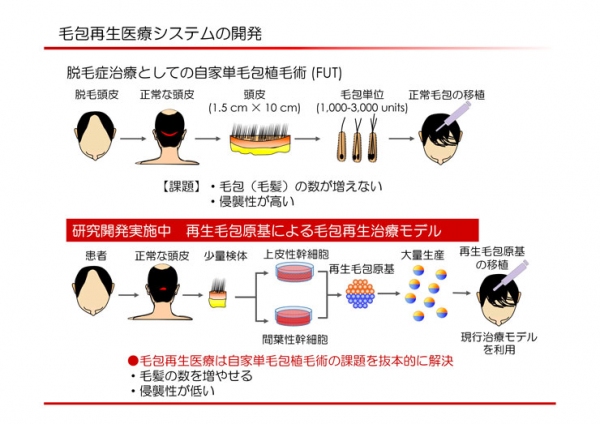 再生医療技術による脱毛症の治療イメージ（京セラ発表資料より）