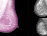 乳がん検査、マンモグラフィーの画像。