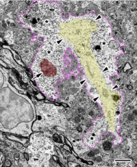 細胞断片（赤い部分）を取り込んだアストロサイト（ピンクで囲まれた部分）。（画像：山梨大学発表資料より）
