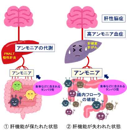 肝性脳症。（画像:日本医療研究開発機構発表資料より）