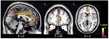 オキシトシン反復投与で脳活動改善効果を有意に認めたヒト脳の内側前頭前野。（画像:日本医療研究開発機構発表資料より）