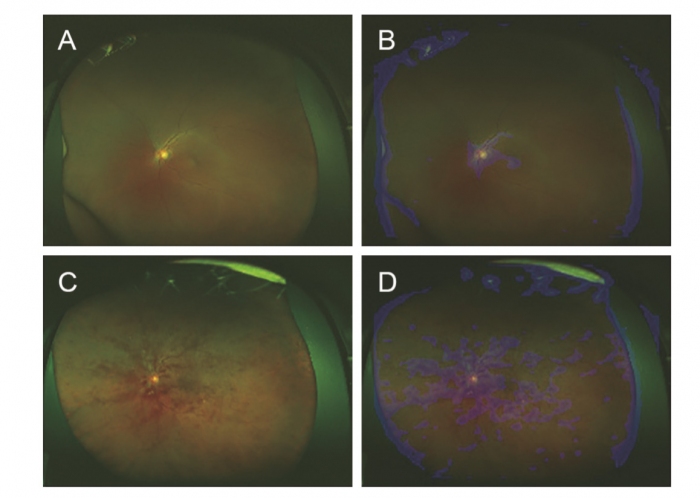 広角眼底画像（A:正常眼　B:Aのヒートマップ　C: 網膜中心静脈閉塞症の眼　D:Cのヒートマップ）(画像: Ristの発表資料より)