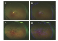 広角眼底画像（A:正常眼　B:Aのヒートマップ　C: 網膜中心静脈閉塞症の眼　D:Cのヒートマップ）(画像: Ristの発表資料より)