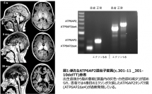 患者から発見された脳神経疾患に関与するタンパク質「ATP6AP2」の遺伝子変異。（写真：東北大の発表資料より）