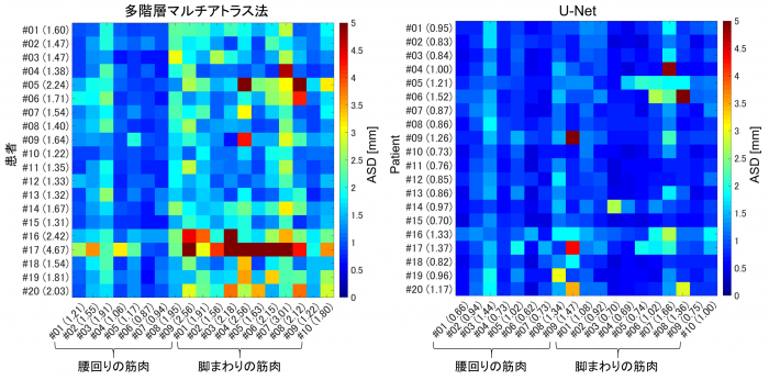 図2: 図1による20例の実験での誤差分布。左が従来法で右が今回開発された方法による結果。それぞれ、縦軸が異なる患者、横軸が異なる筋肉に対応しており、青が小さい誤差、緑、黄、赤となるにつれ、大きな誤差を表す。実用精度の目安となる1mm以下の平均誤差を達成している。