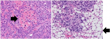 TNIK阻害薬により骨肉腫を脂肪細胞へ変化させる様子（画像: 国立がん研究センターの発表資料より）