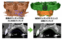 インプラントの3Dガイド技術で特許を取得