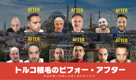 トルコ植毛のビフォーアフター