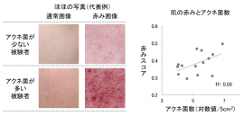 肌の赤みとアクネ菌数との関係