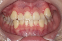 日本人に最適化した歯列矯正治療法「JET system」により、7か月で治療完了