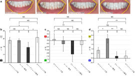 図1. アプリで撮影したホワイトニング前後の歯の画像(a)と色の変化(b-d)
