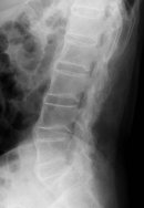 図1：強直性脊椎炎の脊椎レントゲン写真
