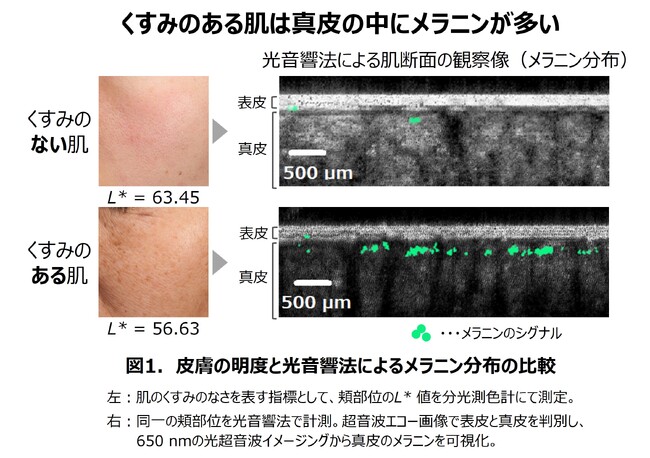 真皮にたまったメラニンがくすみ肌の原因に