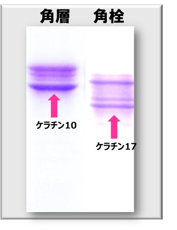 毛穴の角栓形成にケラチン17とアクネ菌の関与を発見