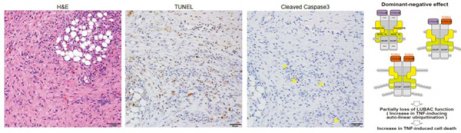 稀少遺伝性自己炎症性疾患：OTULIN関連自己炎症症候群の新たな病態を解明