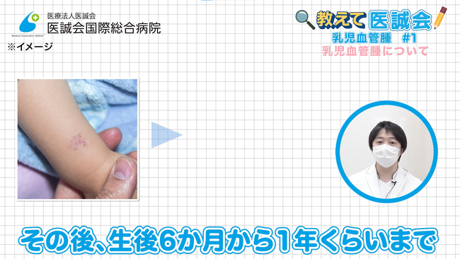 【動画公開】乳児血管腫～乳児血管腫について～／教えて医誠会