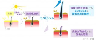 過酸化脂質が多い皮膚でのミノキシジル発毛作用を実証【大正製薬】