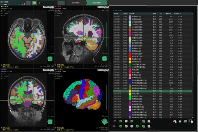 AI(人工知能)を用いた脳容積解析ソフトウェアを開発