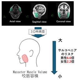 咬筋容積の低下がサルコペニアリスクを高める