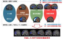 “脳を見える化” 複数の精神疾患で共通する異常を明らかに