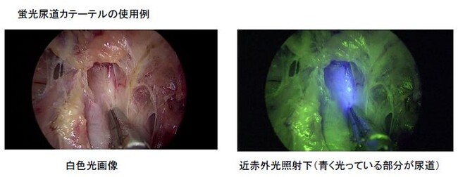 国立がん研究センター東病院とカーディナルヘルス株式会社の共同研究により開発した近赤外光照射下で蛍光反応を示す尿道カテーテルが医療機器として承認されました