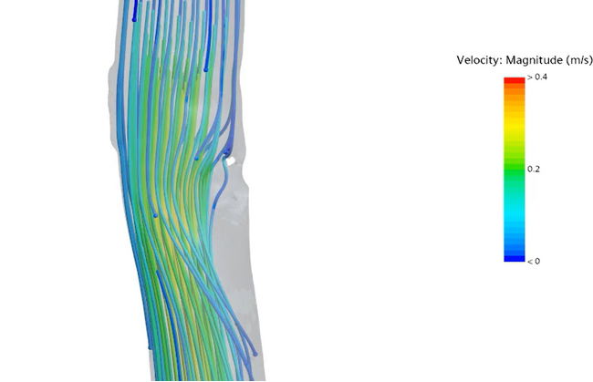 【学会発表】弘前大学との共同研究「SPシャント手術の血流制御法におけるCFD(数値流体力学)研究」（2024年度日本胸部外科学会）