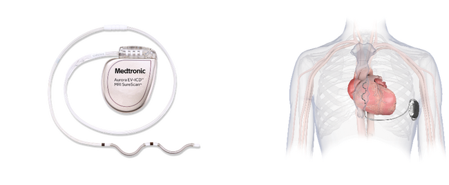 日本メドトロニック　血管外に留置する植込み型除細動器「Aurora EV ICD(TM) MRIデバイス」「Epsila EV(TM) MRIリード」を販売