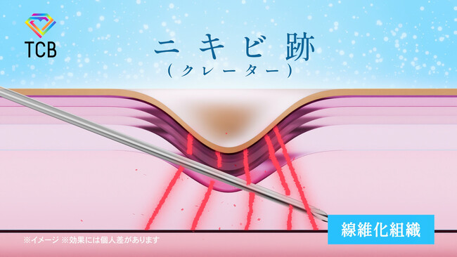 TCB東京中央美容外科の新テレビCM「デコボコしたニキビ跡改善」篇　3月1日(土）より全国でオンエア開始