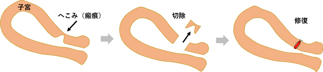 帝王切開瘢痕症候群に対する新しい腹腔鏡下手術の術式