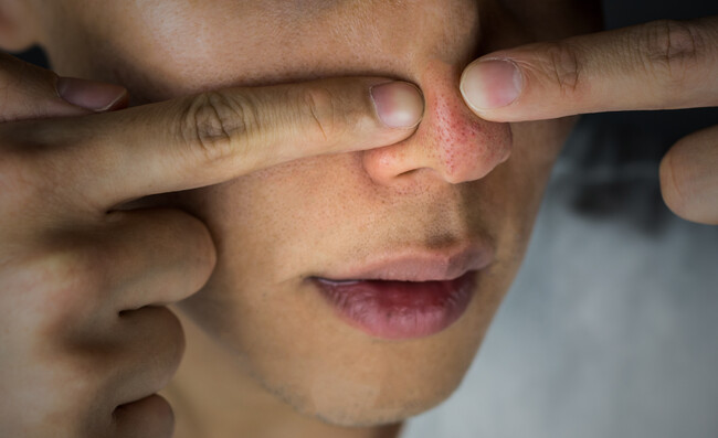 ■【男性9,419名の調査で判明】「毛穴」に悩む男性多数も 治療認知度はわずか16.3％ ／ 毛穴治療の普及目指し9,800円で試せる「ダーマペントライアル（塗る麻酔込み）」を開始