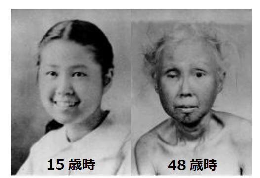 世界初！早老症ウェルナー症候群患者さんを対象とする臨床試験～ニコチンアミド リボシドが動脈硬化指標、難治性潰瘍、腎機能改善に有効