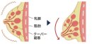 クーパー靭帯に大きく負担