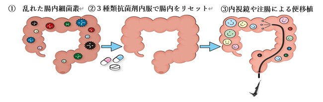 寛解導入率45.9％を達成 ―潰瘍性大腸炎に対する腸内細菌叢移植療法