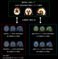 【横浜市立大学】新型コロナウイルス感染症の後遺症“ブレインフォグ”の病態を新しい脳画像法で解明