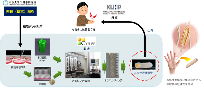 末梢神経損傷に対する同種臍帯由来間葉系細胞を用いた三次元神経導管移植治療の医師主導治験の開始