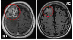 膠芽腫の画像起源の解明～いつから腫瘍は存在していたのか？～（北里大学）