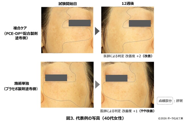 レーザートーニング施術とPCE‐DP(R)（ピース ディーピー）配合製剤の複合ケアの安全性と有効性をクリニックと共同で実証