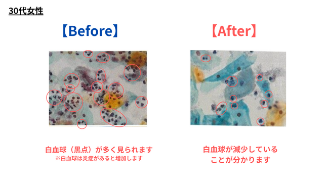 デリケートゾーンソープ、およびオイル使用による膣内フローラ調査結果