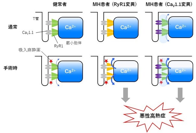 手術時に発症する難治性疾患の新たな原因を解明